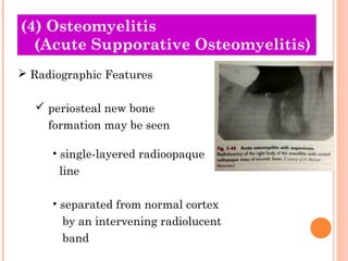 (4) Osteomyelitis
  (Acute Supporative Osteomyelitis)
 Radiographic Features

   periosteal new bone
     formation may ...