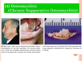 (4) Osteomyelitis
  (Chronic Supporative Osteomyelitis)
 