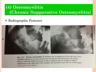 (4) Osteomyelitis
  (Chronic Supporative Osteomyelitis)
 Radiographic Features
 