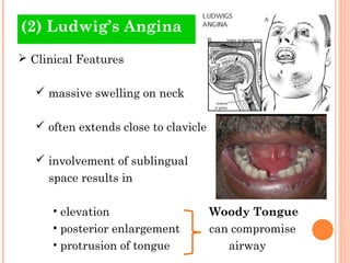 (2) Ludwig’s Angina
 Clinical Features

    massive swelling on neck

    often extends close to clavicle

    involve...