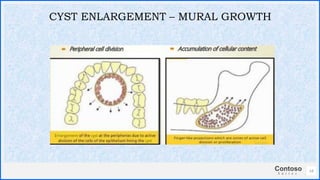 Contoso
S u i t e s
14
CYST ENLARGEMENT – MURAL GROWTH
 