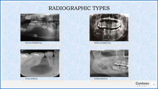 Contoso
S u i t e s
ENVELOPMENTAL
COLLATERAL
REPLACEMENTAL
EXTRANEOUS
18
RADIOGRAPHIC TYPES
 
