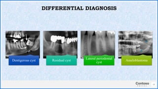 Contoso
S u i t e s
19
DIFFERENTIAL DIAGNOSIS
Dentigerous cyst Residual cyst
Lateral periodontal
cyst
Ameloblastoma
 