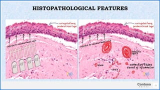 Contoso
S u i t e s
21
HISTOPATHOLOGICAL FEATURES
 