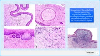 Contoso
S u i t e s
22
Separation of the epithelium
from the supporting
connective is caused by
metalloproteinases-mediated
degradation of collagen in
the juxta-epithelial regions
 