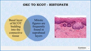 Contoso
S u i t e s
Basal layer
of KCOT
budding
into the
connective
tissue
Mitotic
figures are
frequently
found in
suprabasal
layers
29
OKC TO KCOT - HISTOPATH
 