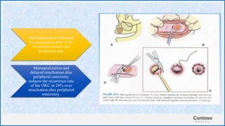 Contoso
S u i t e s
Marsupialization followed
by enucleation after 12 to
18 months reduces the
recurrence rate.
Marsupialization and
delayed enucleation plus
peripheral ostectomy
reduces the recurrence rate
of the OKC in 26% over
enucleation plus peripheral
ostectomy.
 