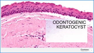 Contoso
S u i t e s
4
ODONTOGENIC
KERATOCYST
 