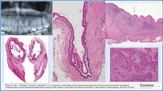 Contoso
S u i t e s
46
Kikuchi K, Ide F, Takizawa S, Suzuki S, Sakashita H, Li TJ, Kusama K. Initial-stage primary intraosseous squamous cell carcinoma derived from odontogenic
keratocyst with unusual keratoameloblastomatous change of the maxilla: a case report and literature discussion. Case reports in otolaryngology. 2018 Apr 19;2018.
 