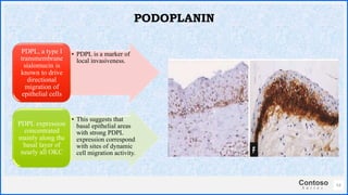Contoso
S u i t e s
• PDPL is a marker of
local invasiveness.
PDPL, a type I
transmembrane
sialomucin is
known to drive
directional
migration of
epithelial cells
• This suggests that
basal epithelial areas
with strong PDPL
expression correspond
with sites of dynamic
cell migration activity.
PDPL expression
concentrated
mainly along the
basal layer of
nearly all OKC
53
PODOPLANIN
 