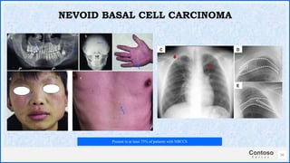 Contoso
S u i t e s
56
NEVOID BASAL CELL CARCINOMA
Present in at least 75% of patients with NBCCS
 