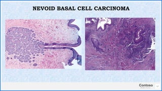 Contoso
S u i t e s
57
NEVOID BASAL CELL CARCINOMA
 