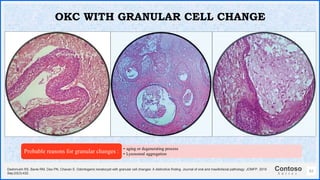 Contoso
S u i t e s
62
OKC WITH GRANULAR CELL CHANGE
Deshmukh RS, Bavle RM, Deo PN, Chavan S. Odontogenic keratocyst with granular cell changes: A distinctive finding. Journal of oral and maxillofacial pathology: JOMFP. 2019
Sep;23(3):432.
• aging or degenerating process
• Lysosomal aggregation
Probable reasons for granular changes :
 