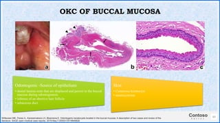 Contoso
S u i t e s
63
OKC OF BUCCAL MUCOSA
Odontogenic -Source of epithelium
• dental lamina rests that are displaced and persist in the buccal
mucosa during odontogenesis
• isthmus of an abortive hair follicle
• sebaceous duct
Skin
• Cutaneous keratocyst
• steatocystoma
Witteveen ME, Flores IL, Karssemakers LH, Bloemena E. Odontogenic keratocysts located in the buccal mucosa: A description of two cases and review of the
literature. SAGE open medical case reports. 2019 May;7:2050313X19849828.
 