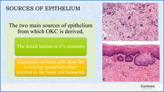 Contoso
S u i t e s
The two main sources of epithelium
from which OKC is derived,
The dental lamina or it’s remnants
Extensions of basal cells from the
overlying epithelium often
referred as the basal cell hamartias
9
SOURCES OF EPITHELIUM
 