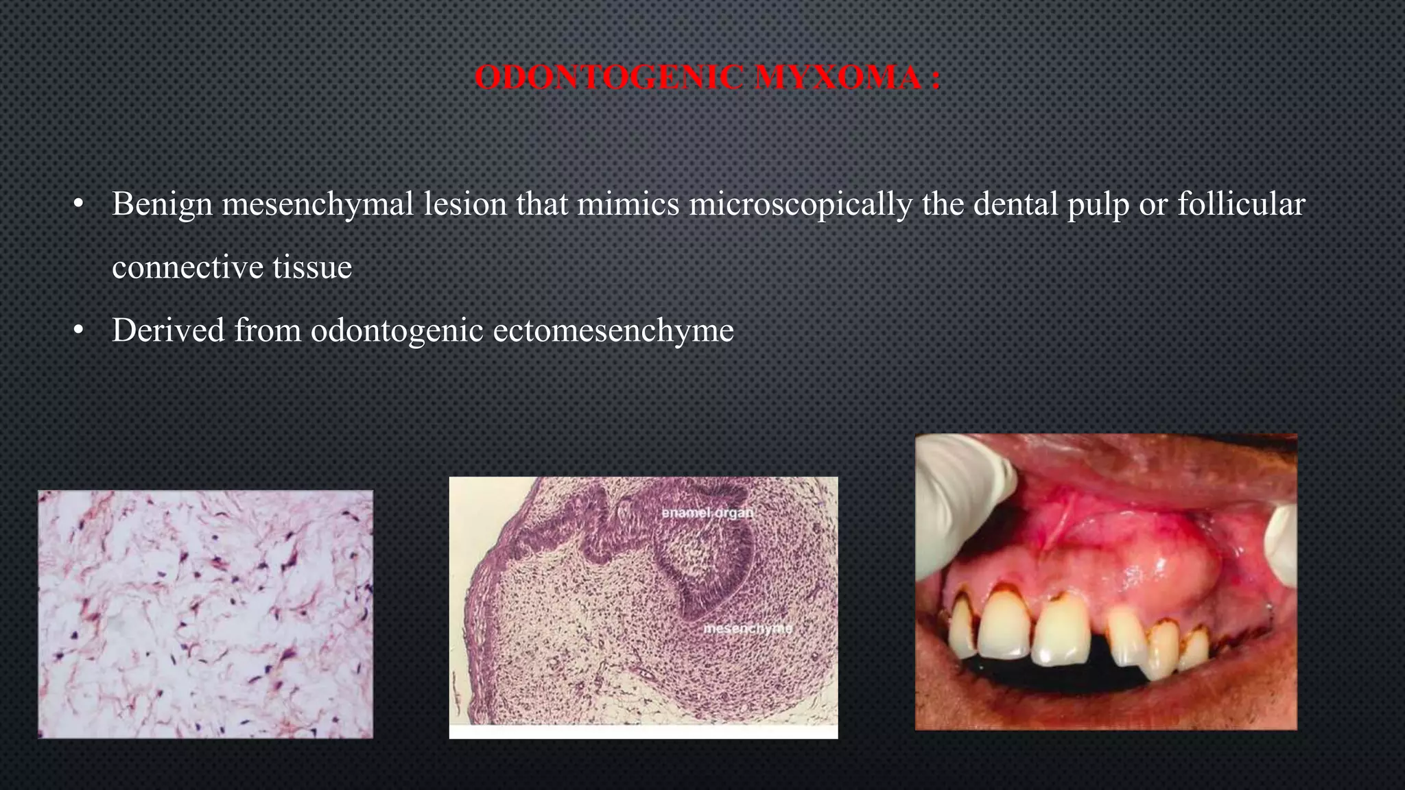 ODONTOGENIC MYXOMA :
• Benign mesenchymal lesion that mimics microscopically the dental pulp or follicular
connective tissue
• Derived from odontogenic ectomesenchyme