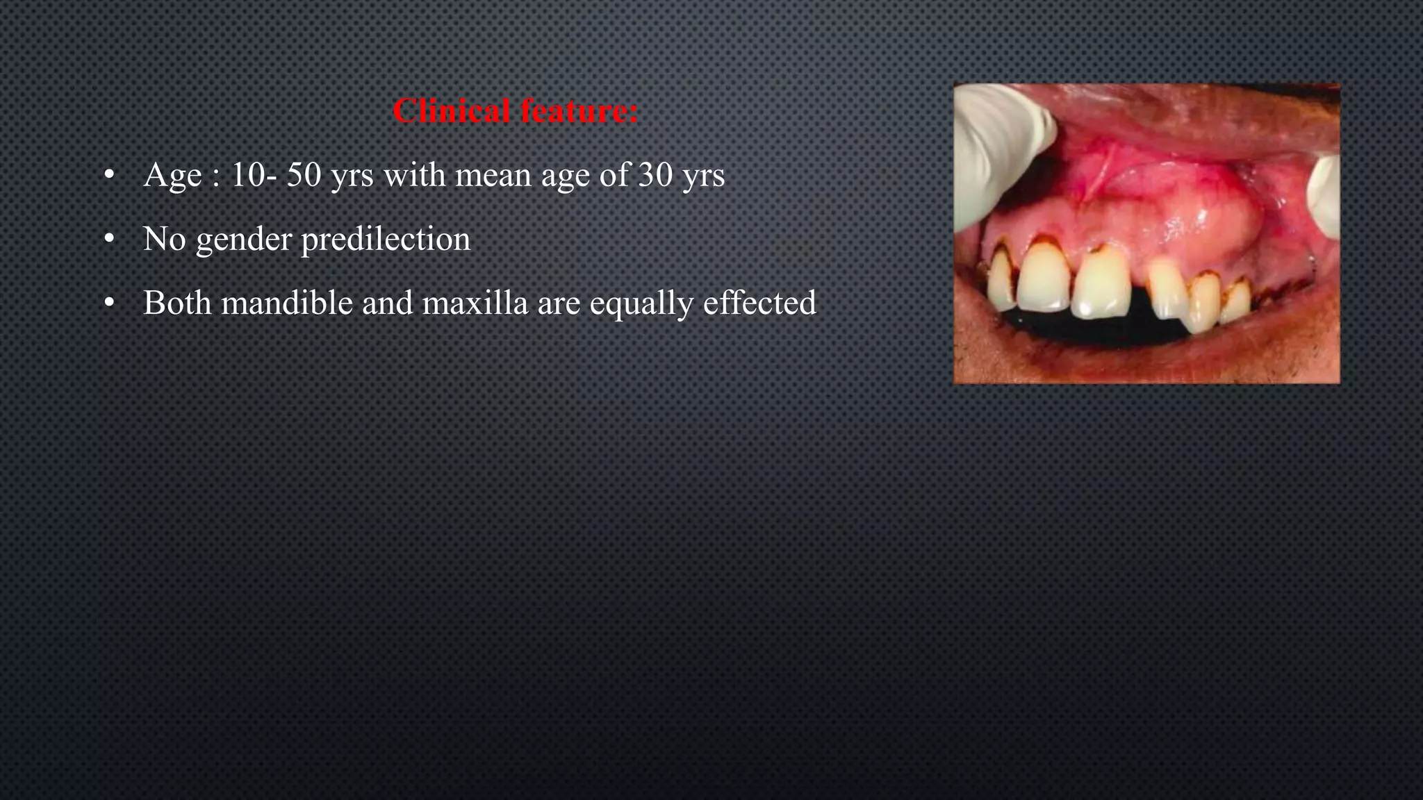 Clinical feature:
• Age : 10- 50 yrs with mean age of 30 yrs
• No gender predilection
• Both mandible and maxilla are equally effected