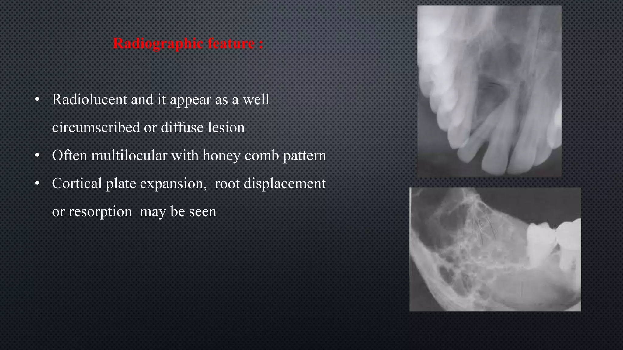 Radiographic feature :
• Radiolucent and it appear as a well
circumscribed or diffuse lesion
• Often multilocular with honey comb pattern
• Cortical plate expansion, root displacement
or resorption may be seen