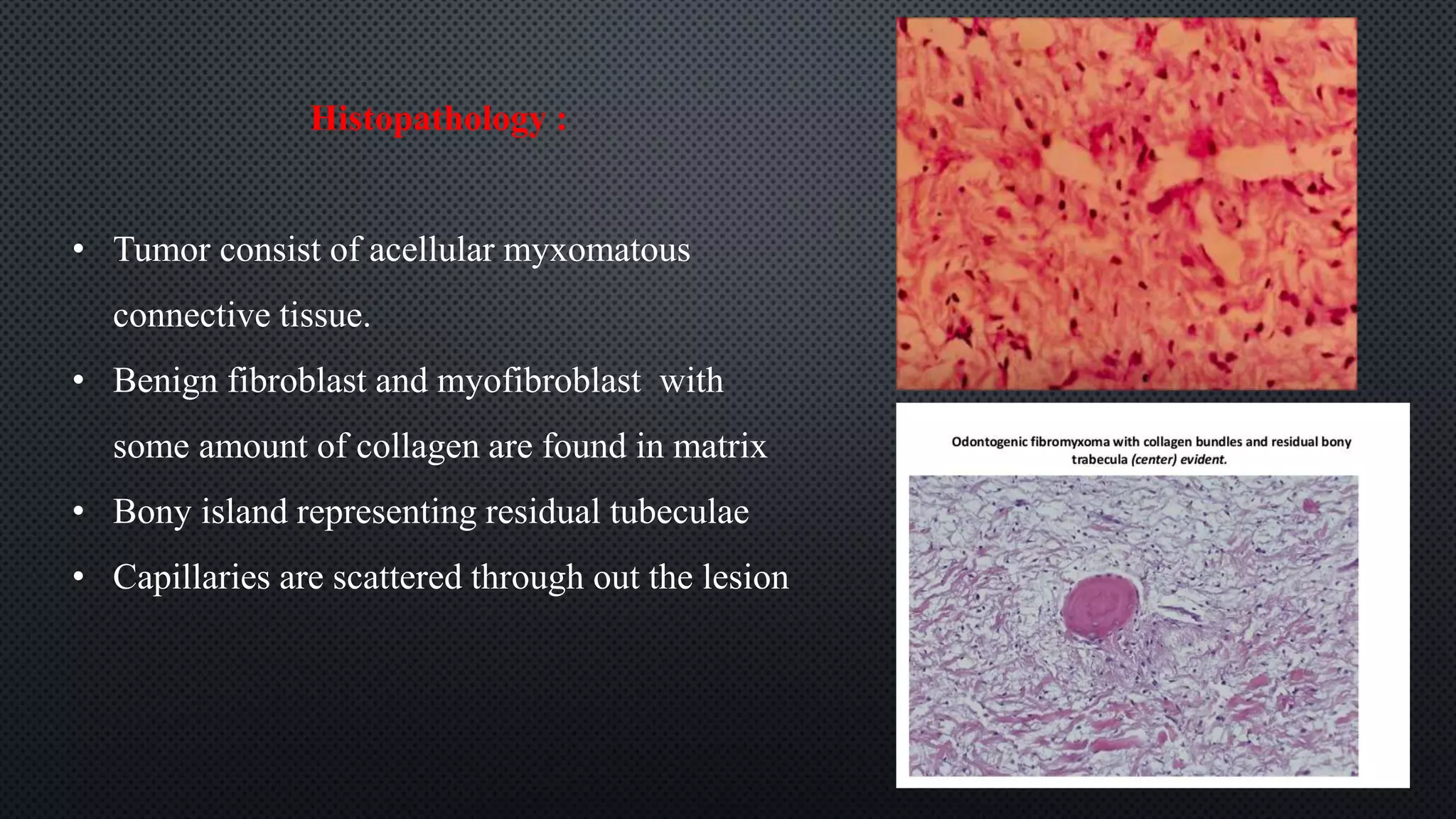 Histopathology :
• Tumor consist of acellular myxomatous
connective tissue.
• Benign fibroblast and myofibroblast with
some amount of collagen are found in matrix
• Bony island representing residual tubeculae
• Capillaries are scattered through out the lesion