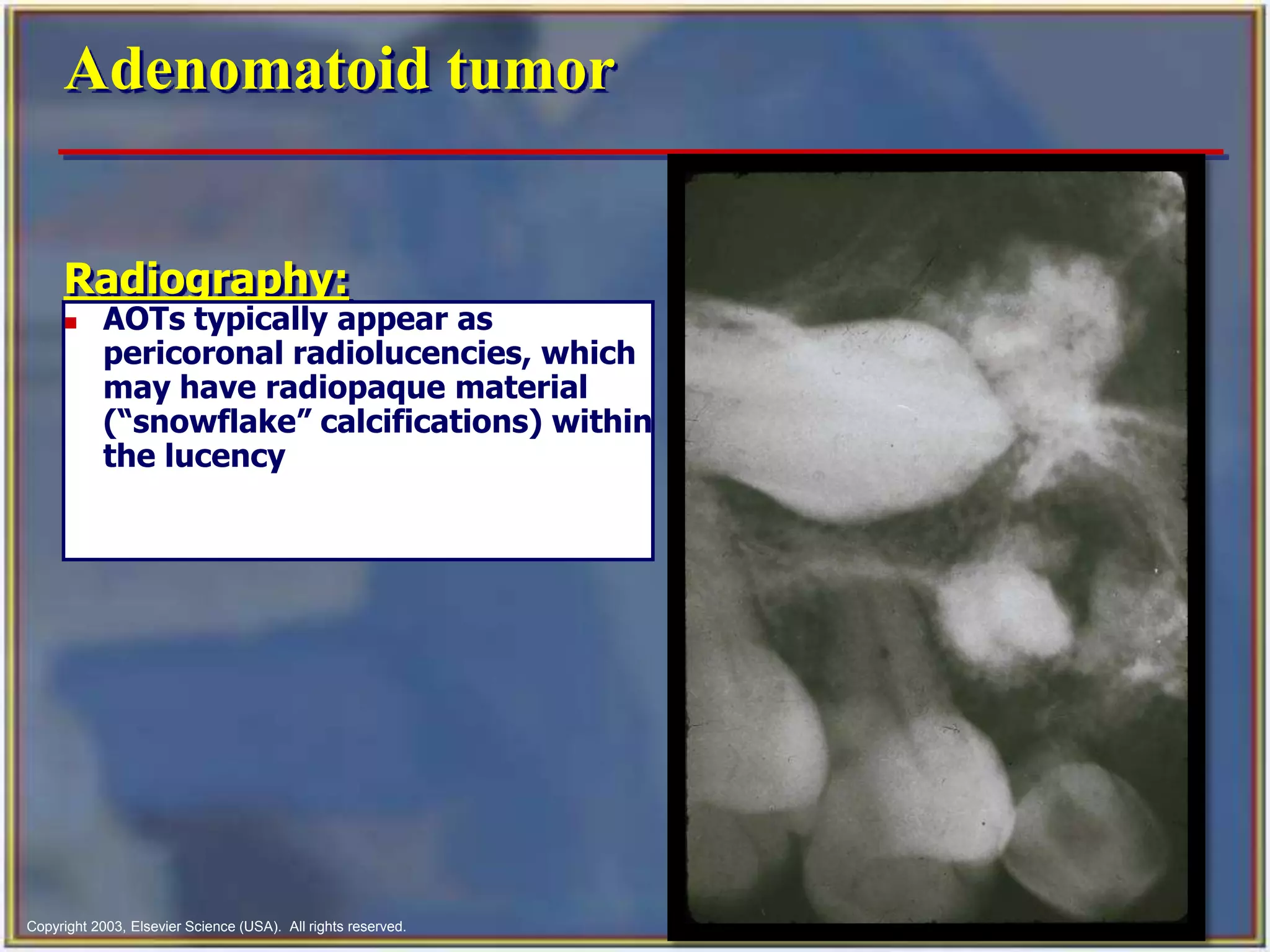 Aot Radiograph Odontogenic tumor | PPTX