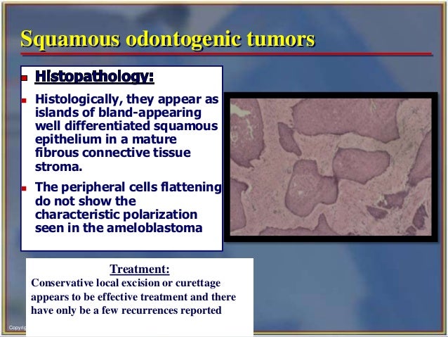 Odontogenic tumor diagram of tooth 31 