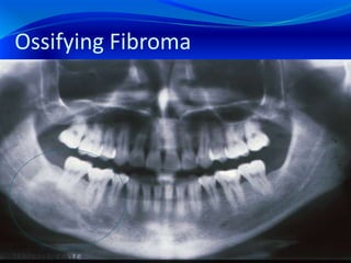Ossifying Fibroma
 