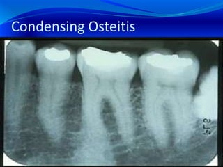 Condensing Osteitis
 