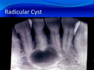 Radicular Cyst
 