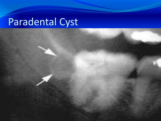 Paradental Cyst
 