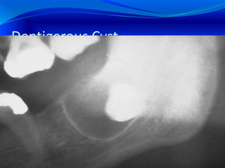 Dentigerous Cyst
 