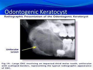 Odontogenic Keratocyst
 