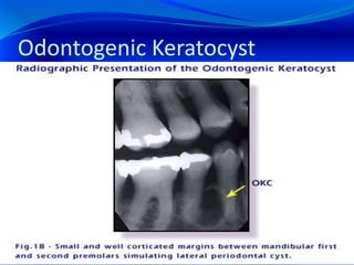 Odontogenic Keratocyst
 
