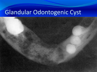 Glandular Odontogenic Cyst
 