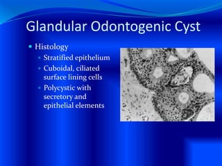 Glandular Odontogenic Cyst
 Histology
 Stratified epithelium
 Cuboidal, ciliated
surface lining cells
 Polycystic with
secretory and
epithelial elements
 