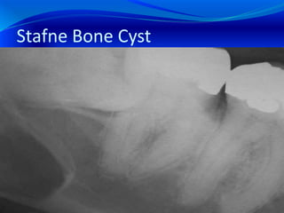Stafne Bone Cyst
 