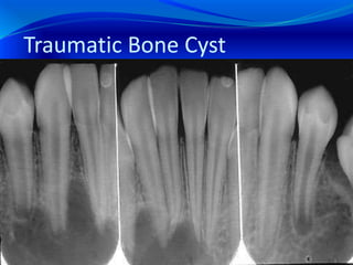 Traumatic Bone Cyst
 