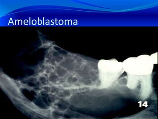 Ameloblastoma
 