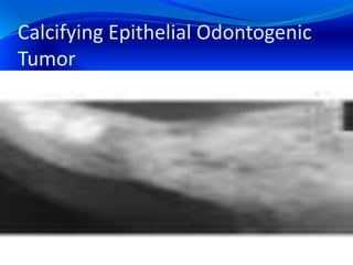 Calcifying Epithelial Odontogenic
Tumor
 