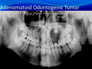 Adenomatoid Odontogenic Tumor
 