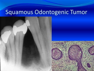Squamous Odontogenic Tumor
 