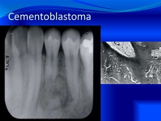 Cementoblastoma
 