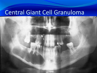 Central Giant Cell Granuloma
 