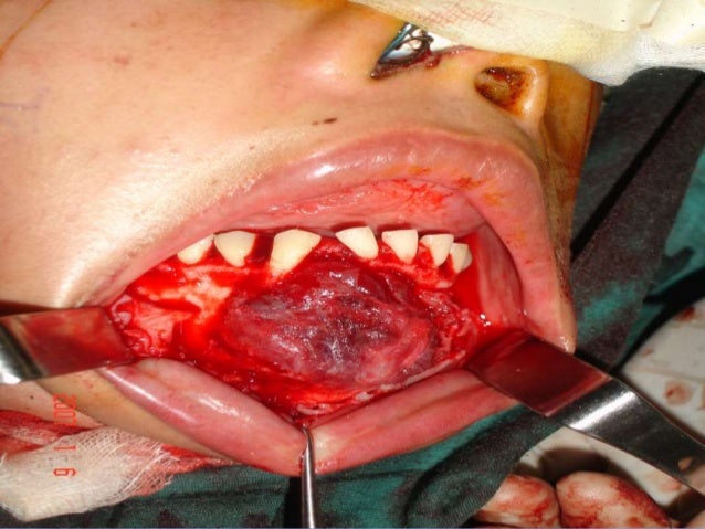 Odontogenic tumors