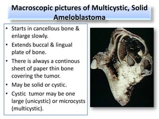 Macroscopic pictures of Multicystic, Solid
             Ameloblastoma
• Starts in cancellous bone &
  enlarge slowly.
• Extends buccal & lingual
  plate of bone.
• There is always a continous
  sheet of paper thin bone
  covering the tumor.
• May be solid or cystic.
• Cystic tumor may be one
  large (unicystic) or microcysts
  (multicystic).
 