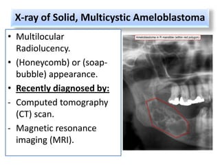 X-ray of Solid, Multicystic Ameloblastoma
• Multilocular
  Radiolucency.
• (Honeycomb) or (soap-
  bubble) appearance.
• Recently diagnosed by:
- Computed tomography
  (CT) scan.
- Magnetic resonance
  imaging (MRI).
 
