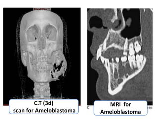 C.T (3d)           MRI for
scan for Ameloblastoma   Ameloblastoma
 