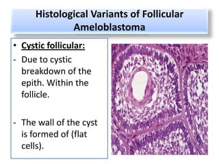 Histological Variants of Follicular
             Ameloblastoma
• Cystic follicular:
- Due to cystic
  breakdown of the
  epith. Within the
  follicle.

- The wall of the cyst
  is formed of (flat
  cells).
 