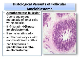 Histological Variants of Follicular
              Ameloblastoma
• Acanthomatous follicular:
- Due to squamous
  metaplasia of inner cells
  within follicle.
- If ↑ keratin →(kerato
  ameloblastoma).
- If some keratinised +
- another microcysts with
  non-keratinised epith.+
- papillary forms→
  (papilliferous kerato-
  ameloblastoma).
 