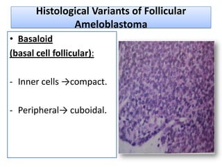 Histological Variants of Follicular
               Ameloblastoma
• Basaloid
(basal cell follicular):

- Inner cells →compact.

- Peripheral→ cuboidal.
 