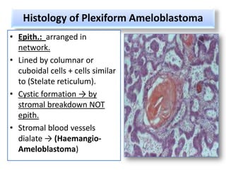 Histology of Plexiform Ameloblastoma
• Epith.: arranged in
  network.
• Lined by columnar or
  cuboidal cells + cells similar
  to (Stelate reticulum).
• Cystic formation → by
  stromal breakdown NOT
  epith.
• Stromal blood vessels
  dialate → (Haemangio-
  Ameloblastoma)
 